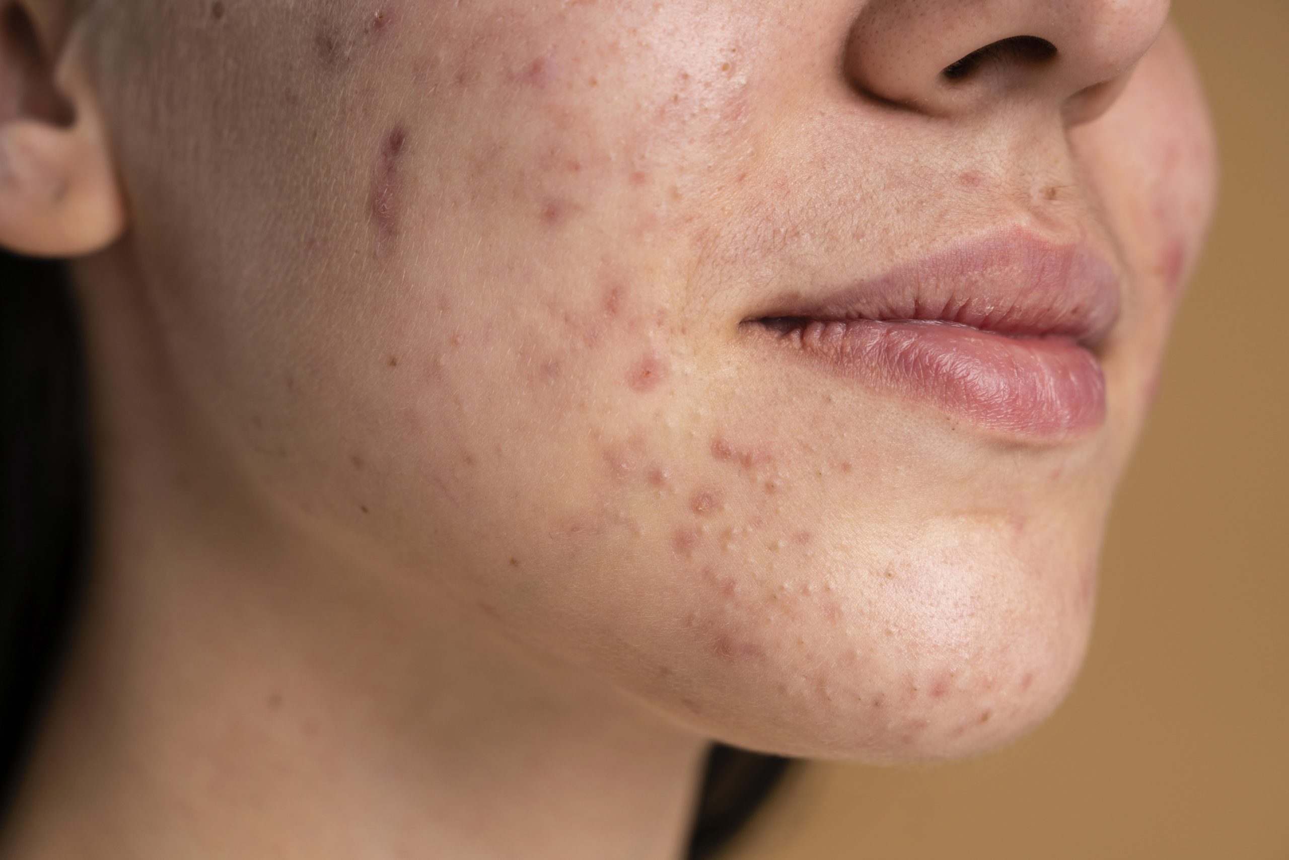 Food that cause acne